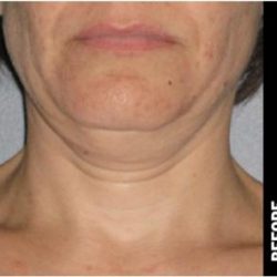 Ultherapy Before & After Patient #1554